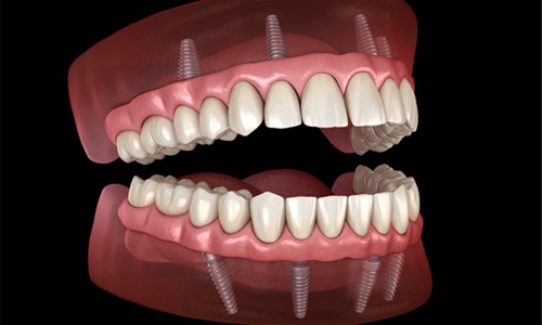 Digital model of All-On-4 dental implants in Worcester