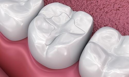 Animation of tooth colored filling placement