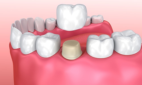 Animation of dental crown placement