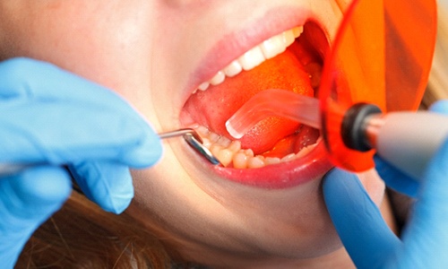 A dentist uses a curing light to bond the composite resin used to fill the patient’s tooth
