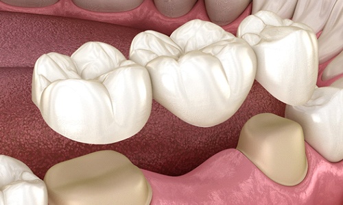 Diagram of dental bridge in Worcester being placed