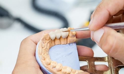 person pointing to a model of a dental crown in Worcester