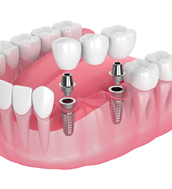 Illustration of a dental implant bridge replacing three teeth