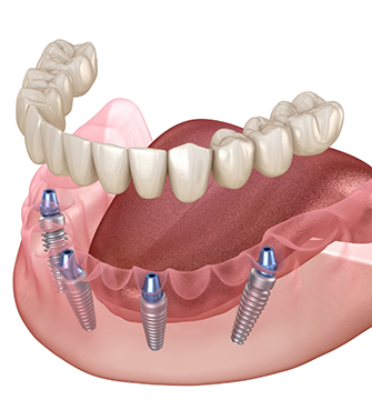 Illustration of an implant denture