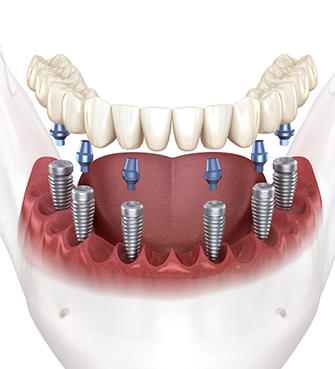 Diagram of an implant denture