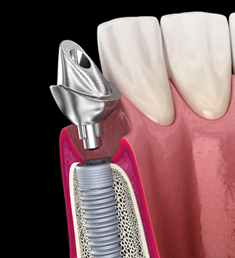 Illustration of a dental implant post in the jawbone