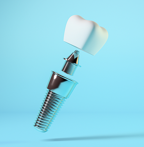Dental implant with crown against pale blue background