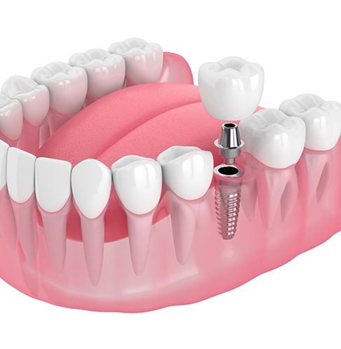 Illustration of a dental implant replacing a tooth