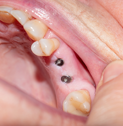 Close-up of dental implant abutments in the jaw where teeth have been lost