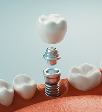 Illustration of a dental implant and crown replacing a tooth