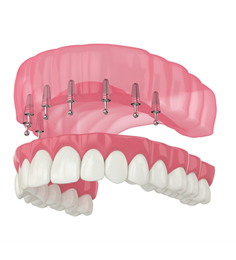 Diagram of an implant denture on the upper arch