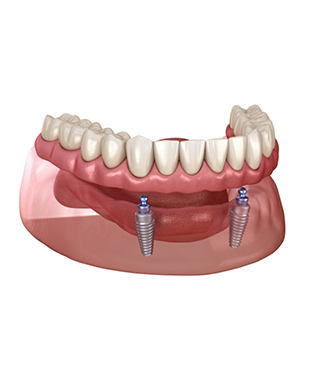Illustration of an implant denture