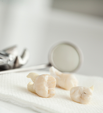 Extracted teeth laying on a gauze pad