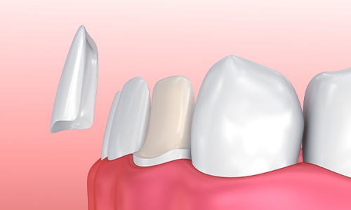 Animation of porcelain veneer placement