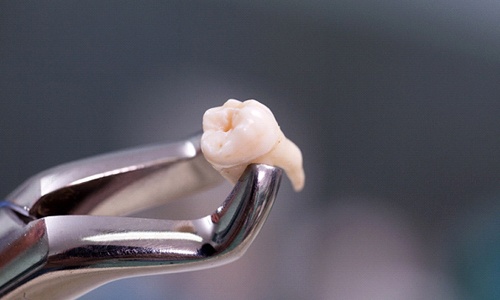 Closeup of dental tool holding fake tooth