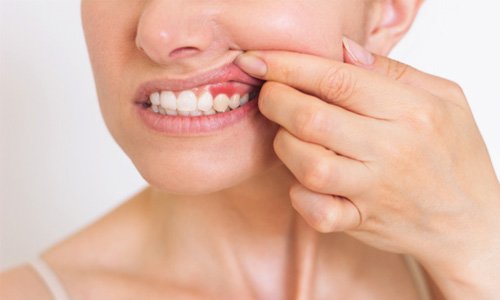 Closeup of patient with red, inflamed gums