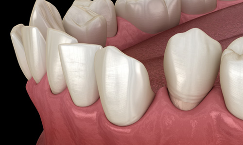 Illustration of gapped teeth