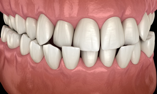 Illustration of a crossbite