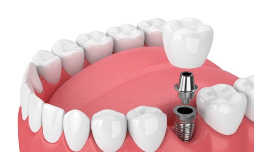 3D illustration of dental implant