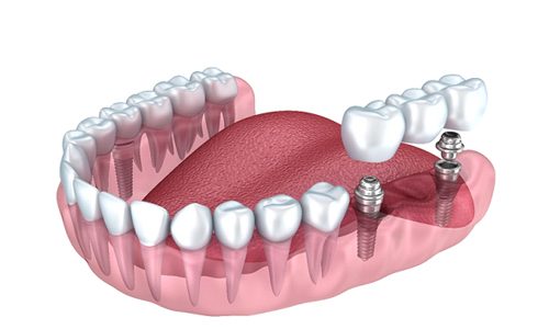 model of bridge and dental implant in Braintree