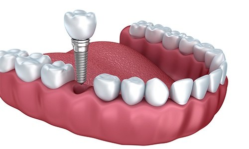 Animation of implant supported dental crown placement