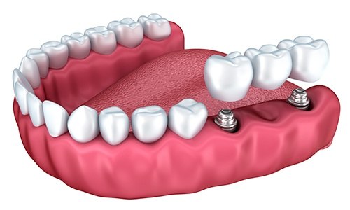 Animation of implant supported fixed bridge placement