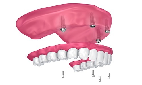 Animation of implant supported denture placement