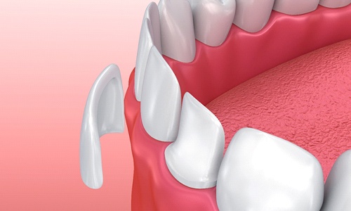 porcelain veneers being added to teeth