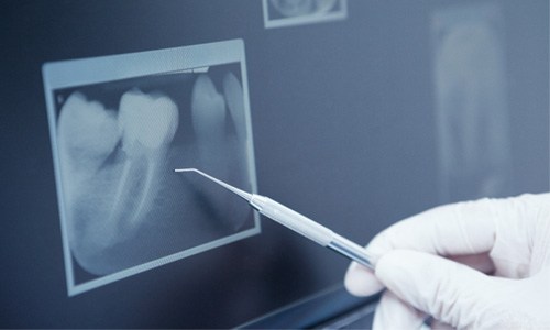 Dentist pointing at patient's X-ray with dental tool