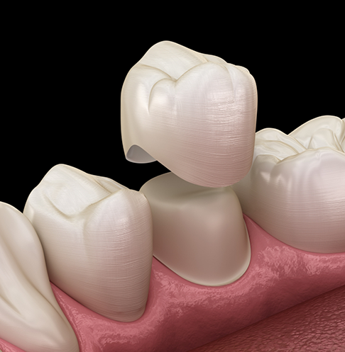 Model of a dental crown fitting over a tooth