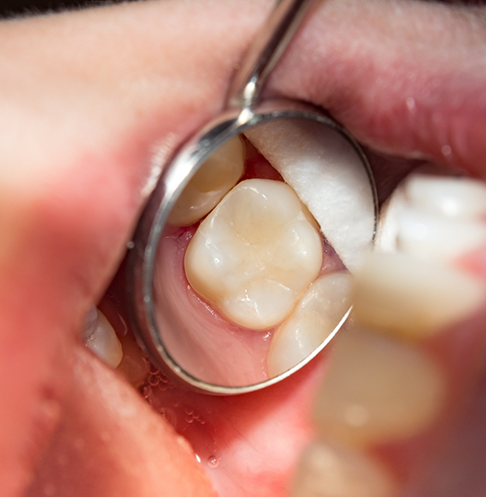 Dental mirror in a mouth