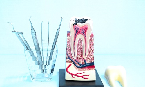 model of a damaged tooth next to a glass full of dental tools