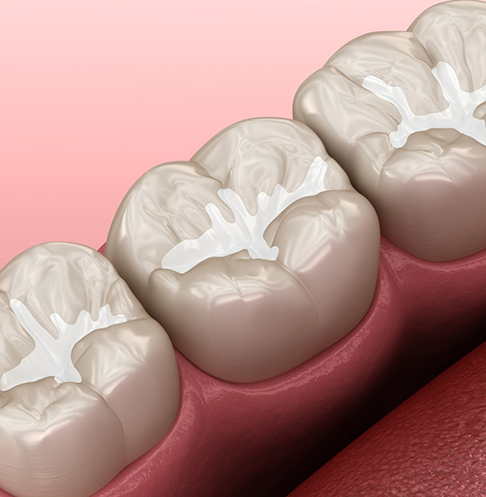 Illustration of tooth with white filling
