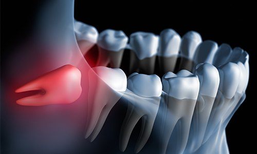 Animation of impacted wisdom tooth