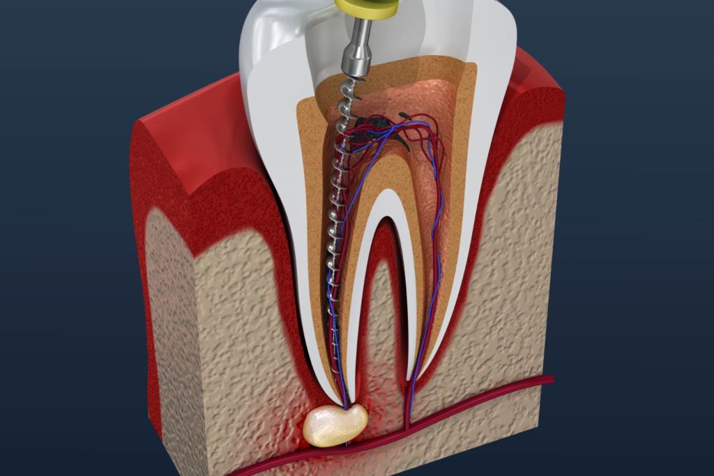 Illustration of root canal therapy