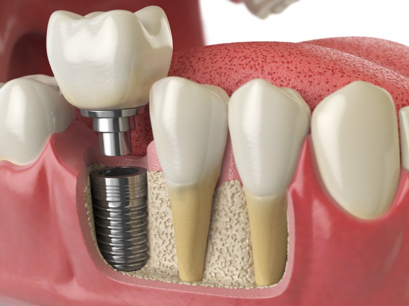 Dental implant illustration