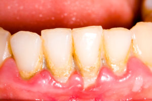 Closeup of patient with gingivitis contagious