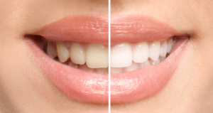 a before and after photo showing teeth whitening results
